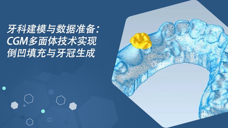 Modeling & Data Prep for Dentistry: CGM Polyhedra Enables Undercut Filling & Tooth Cap Generation